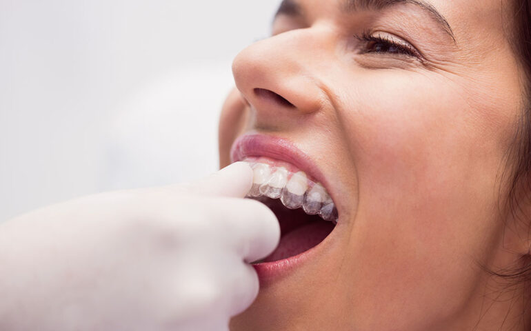 Clear-Aligners-Specialists-in-Gandhinagar
