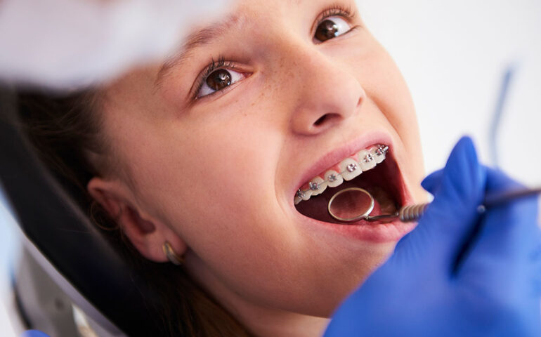 Dental-Braces-Treatment-in-Gandhinagar