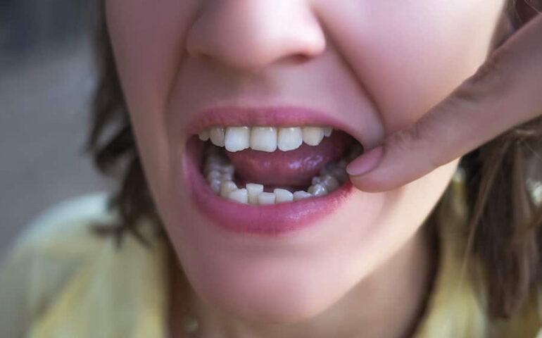 Misaligned Teeth Treatment in Ahmedabad