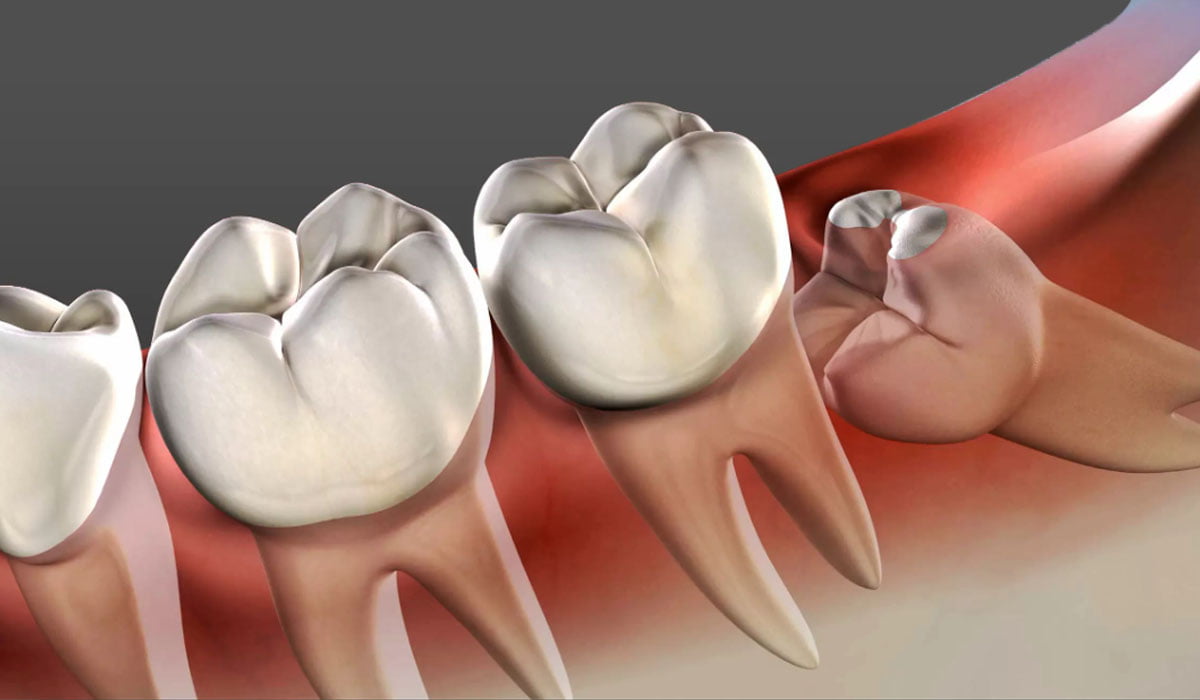 Does Wisdom Tooth Cause Cancer?