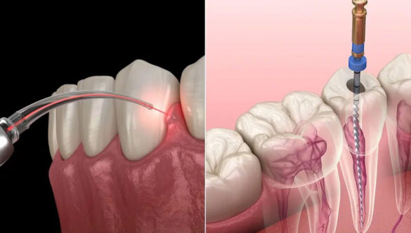 Difference Between Laser and Traditional Root Canal Treatment