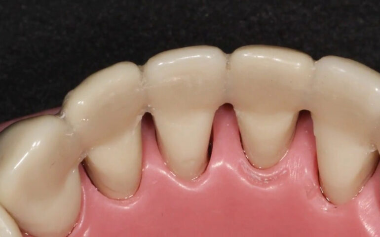 Best Teeth Splinting clinic in Gandhinagar