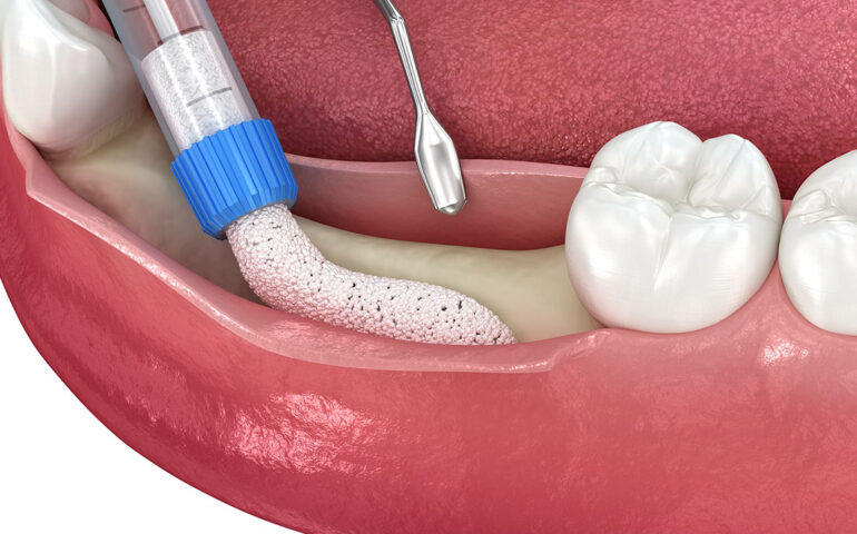 Dental Alveoloplasty
