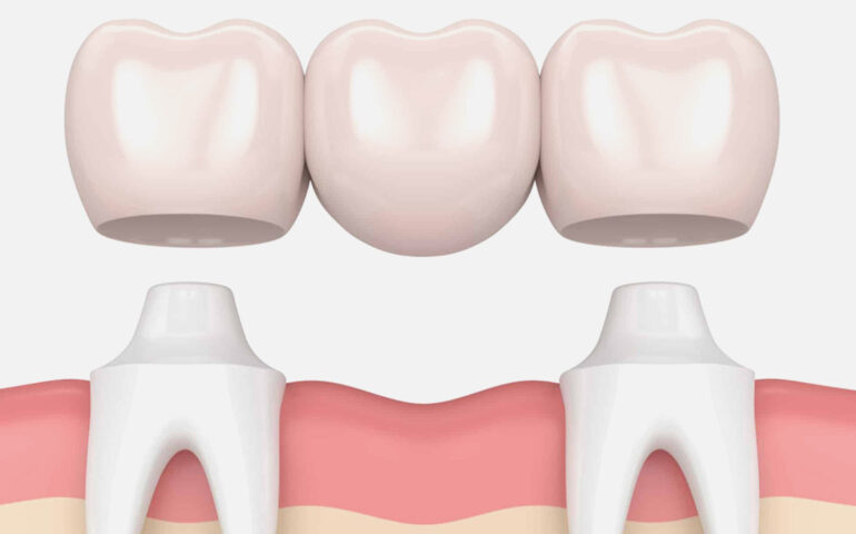 Dental Bridges