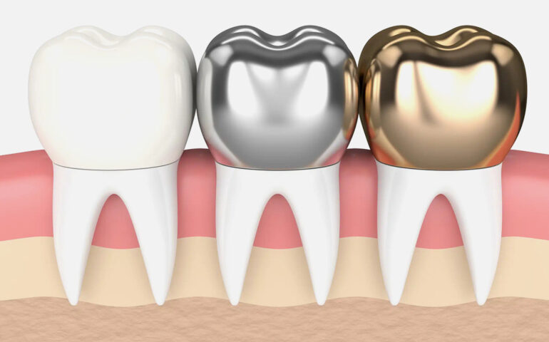 Dental Crowns