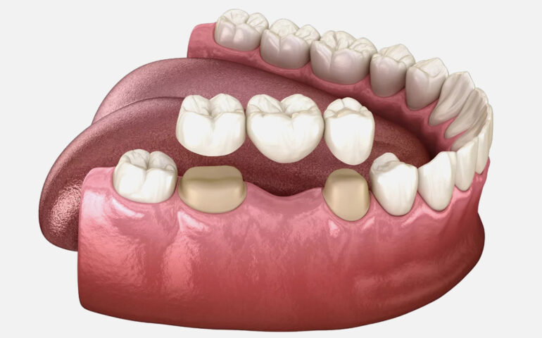 Dental Crowns, Bridges, and Veneers