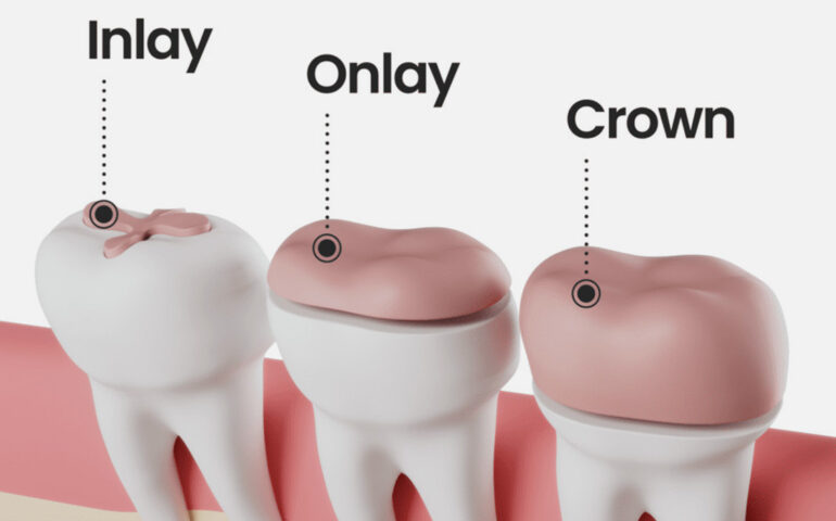 Dental Inlay in Gandhinagar