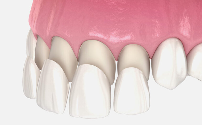 Dental Venners