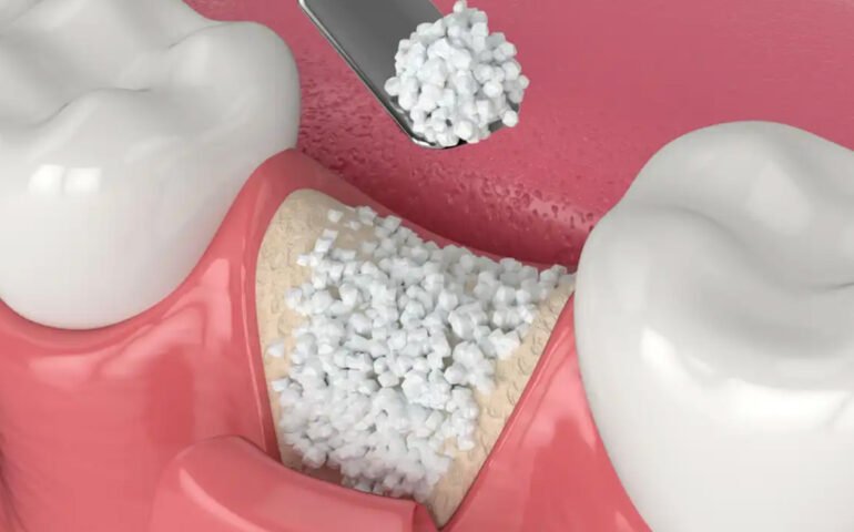 Flap Surgery and Bone Grafting