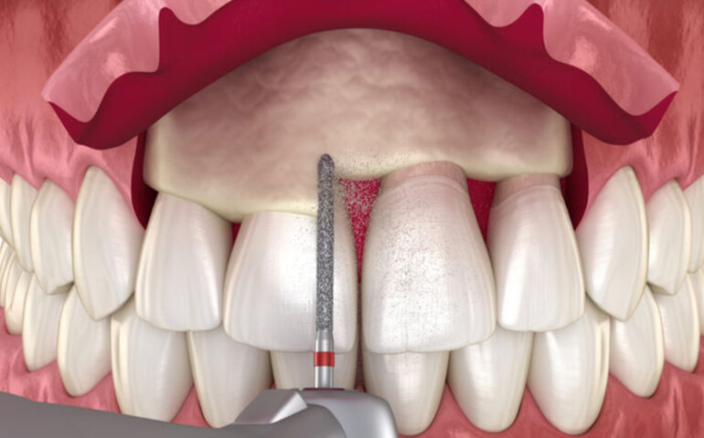 Gingivectomy