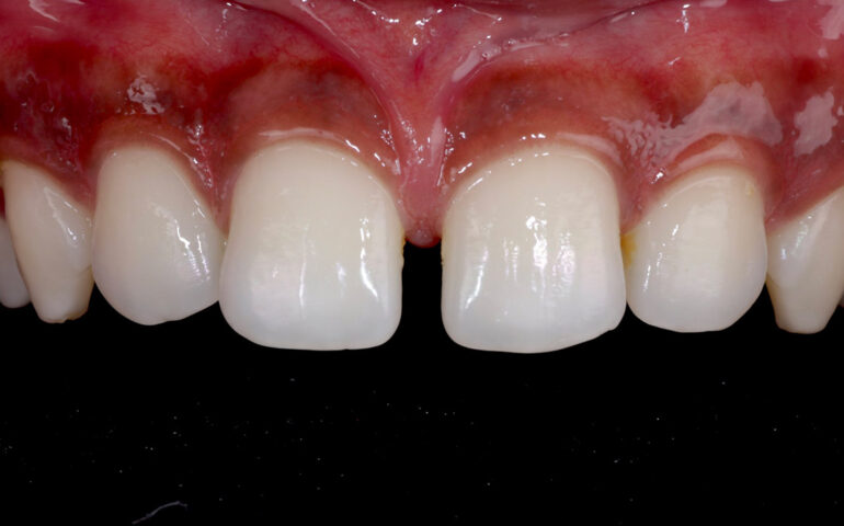 Midline Diastema Closure