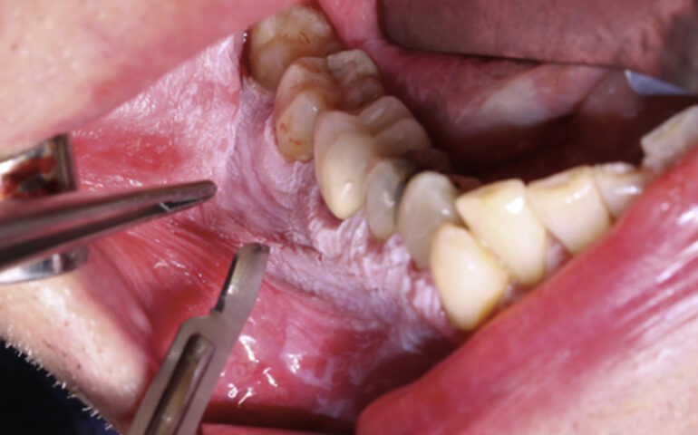 Oral Biopsy