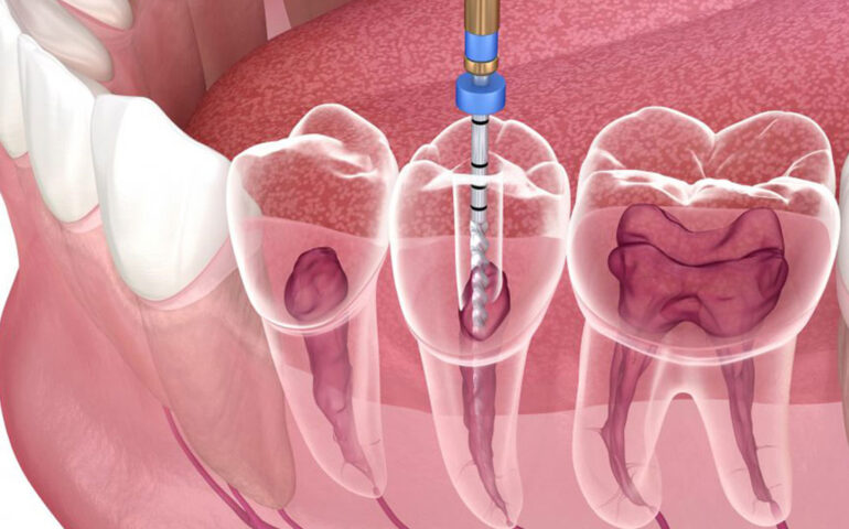 Root Canal Treatment