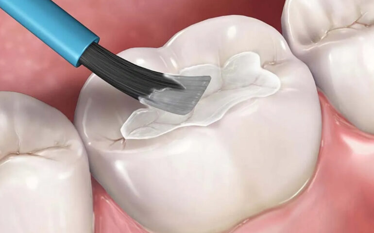 Sealants