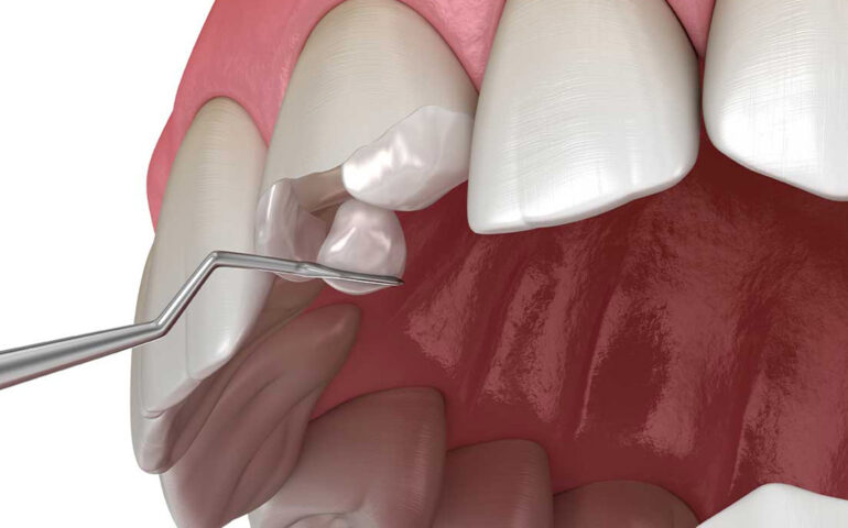 Tooth Colored Filling
