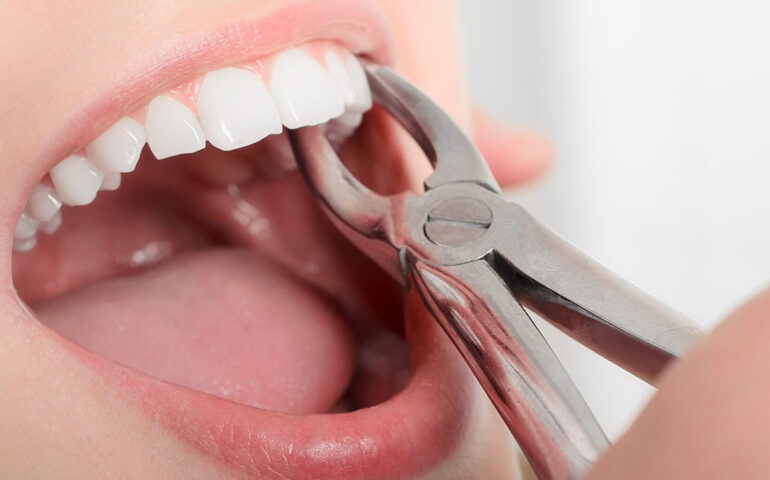 Tooth Extraction